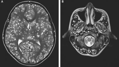 Parasitas